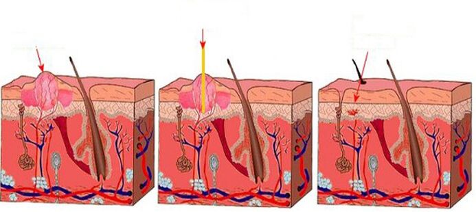 How the laser works on papillomas