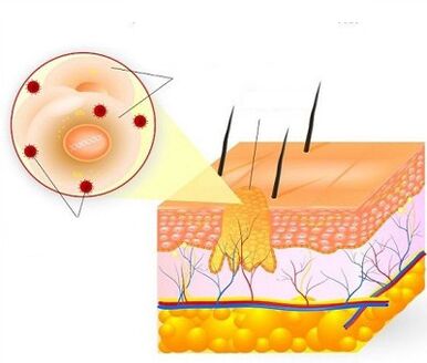 how a wart is formed