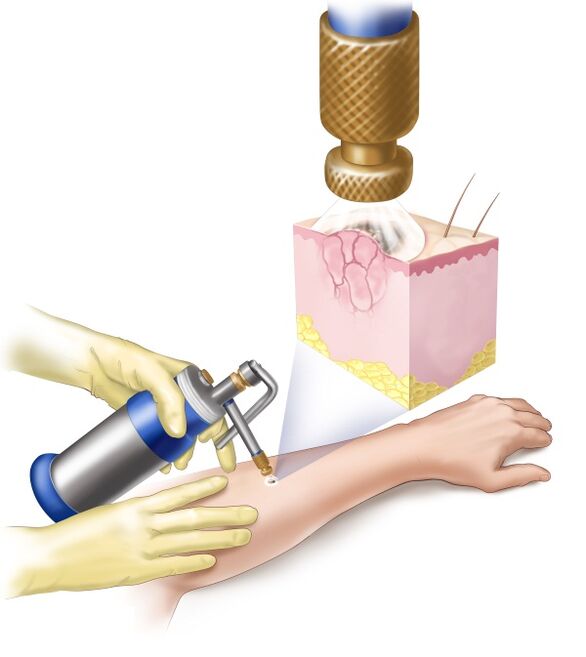 removal of papilloma with liquid nitrogen