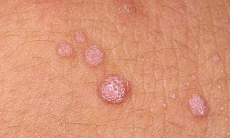 HPV leads to the appearance of papillomas on the skin
