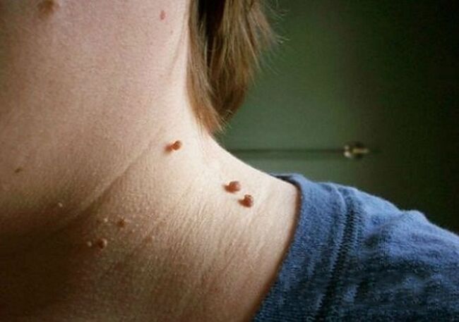 papilloma on the neck