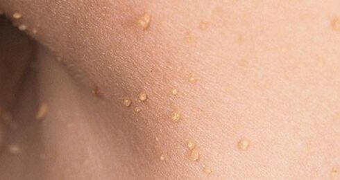 How does the human papillomavirus manifest itself