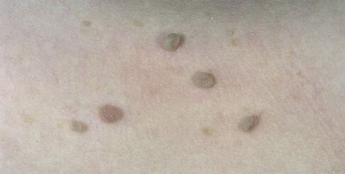 flat warts on human skin