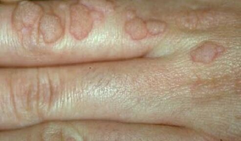 human papilloma virus on the hands