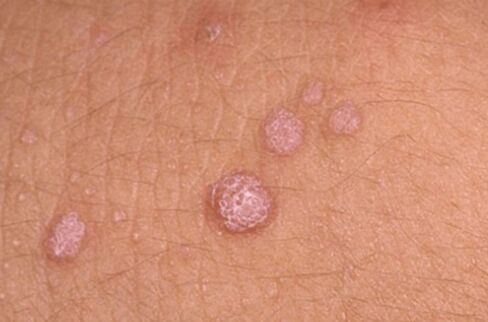 symptoms of human papilloma virus