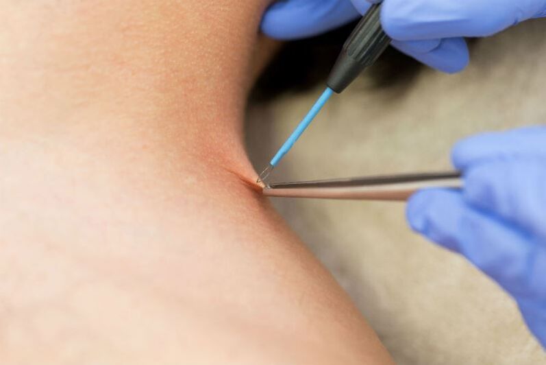 A procedure for removing papillomas using electrocoagulation