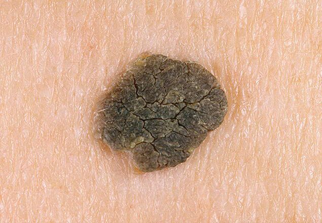 a wart on the skin