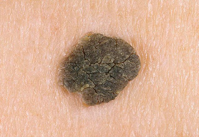 black warts on the skin