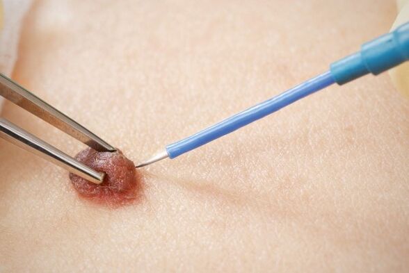Electrocoagulation of papillomas
