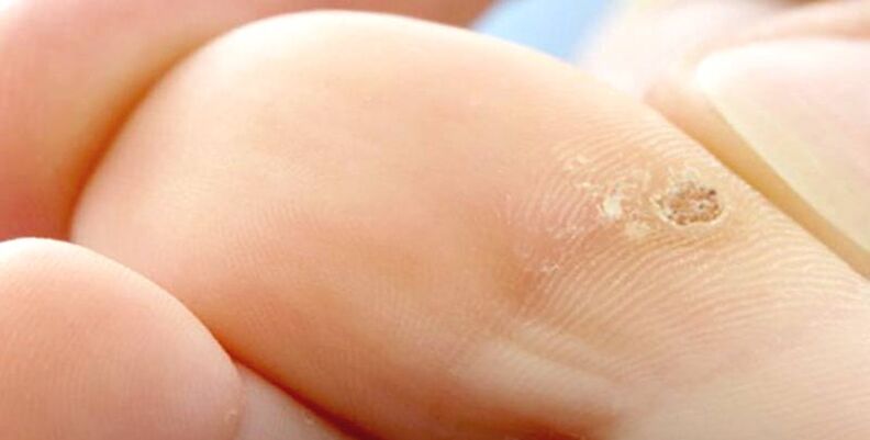 Spike on the finger