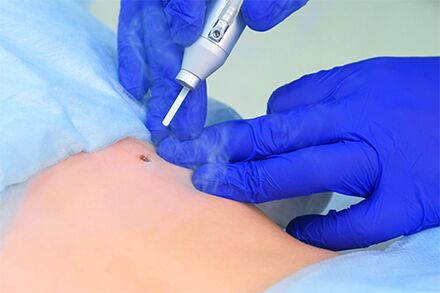 laser removal of papillomas