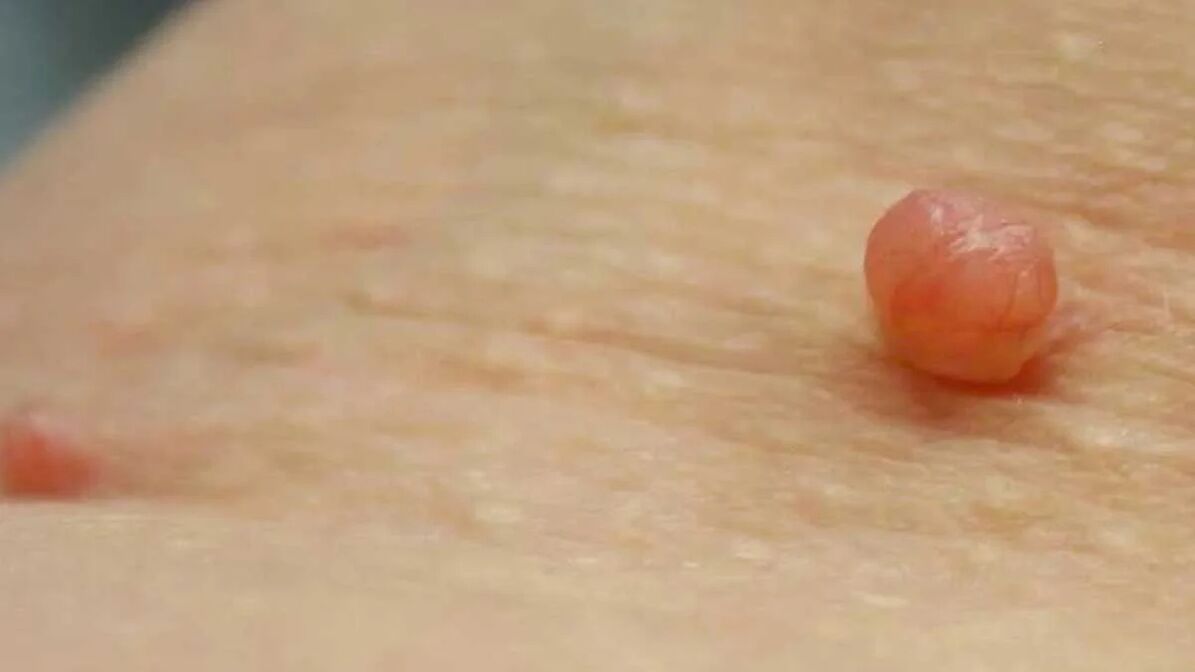 papilloma removal at home
