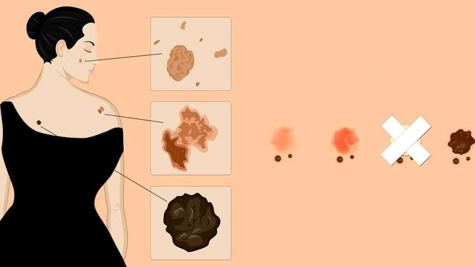 types of papilloma on human skin