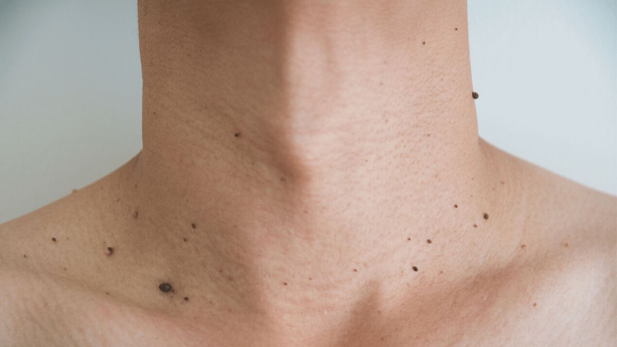 treatment with Keramin cream for papillomas of the neck and chest